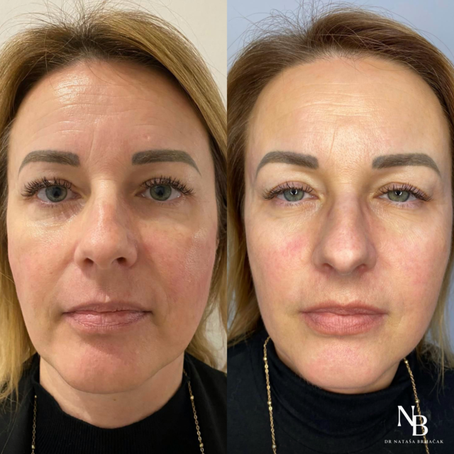 Slika: PROFHILO Structura lica - “sinkers” tip lica