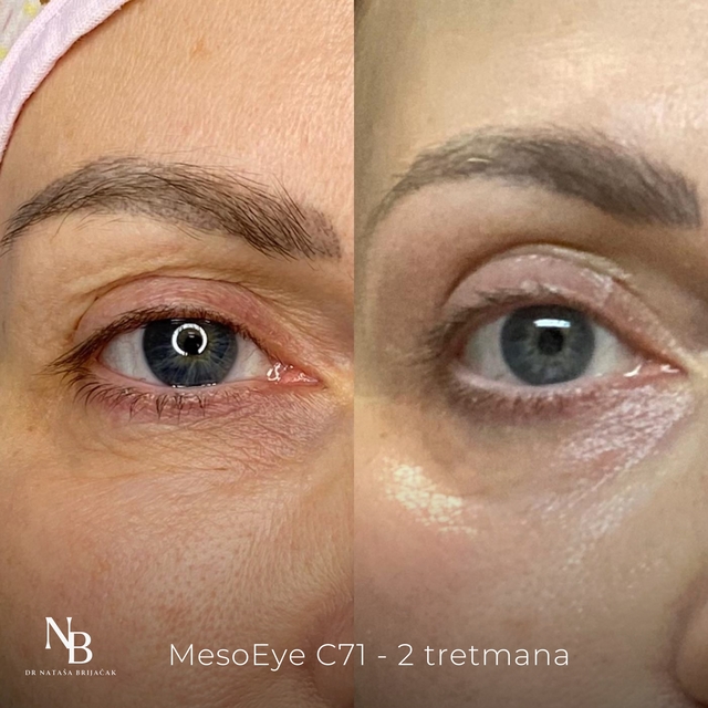 MesoEye C71 - 2 tretmana