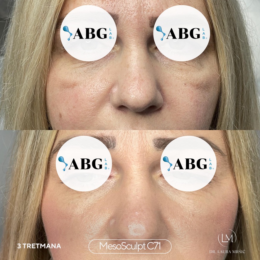 MesoSculpt – malarna regija (3 tretmana)