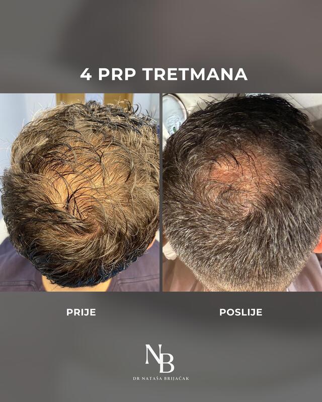 PRP tretman